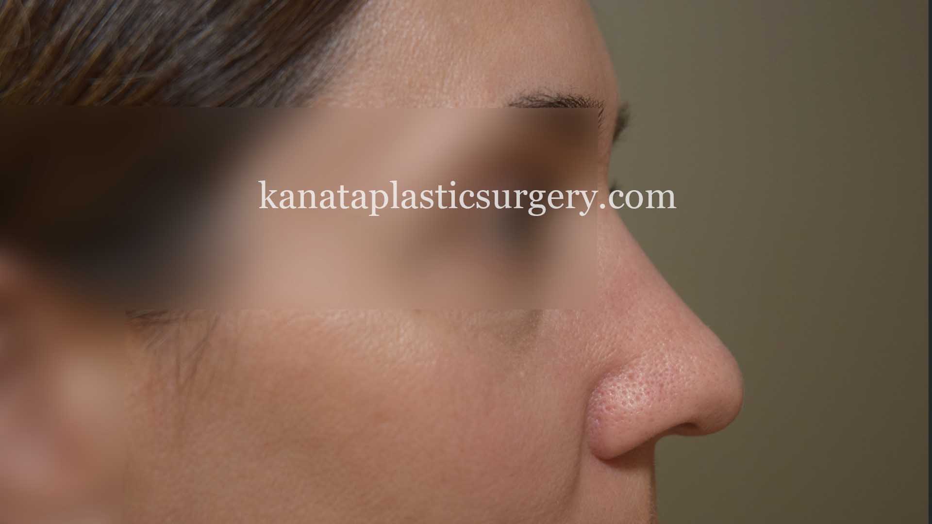 rhinoplasty nose job surgeon 2