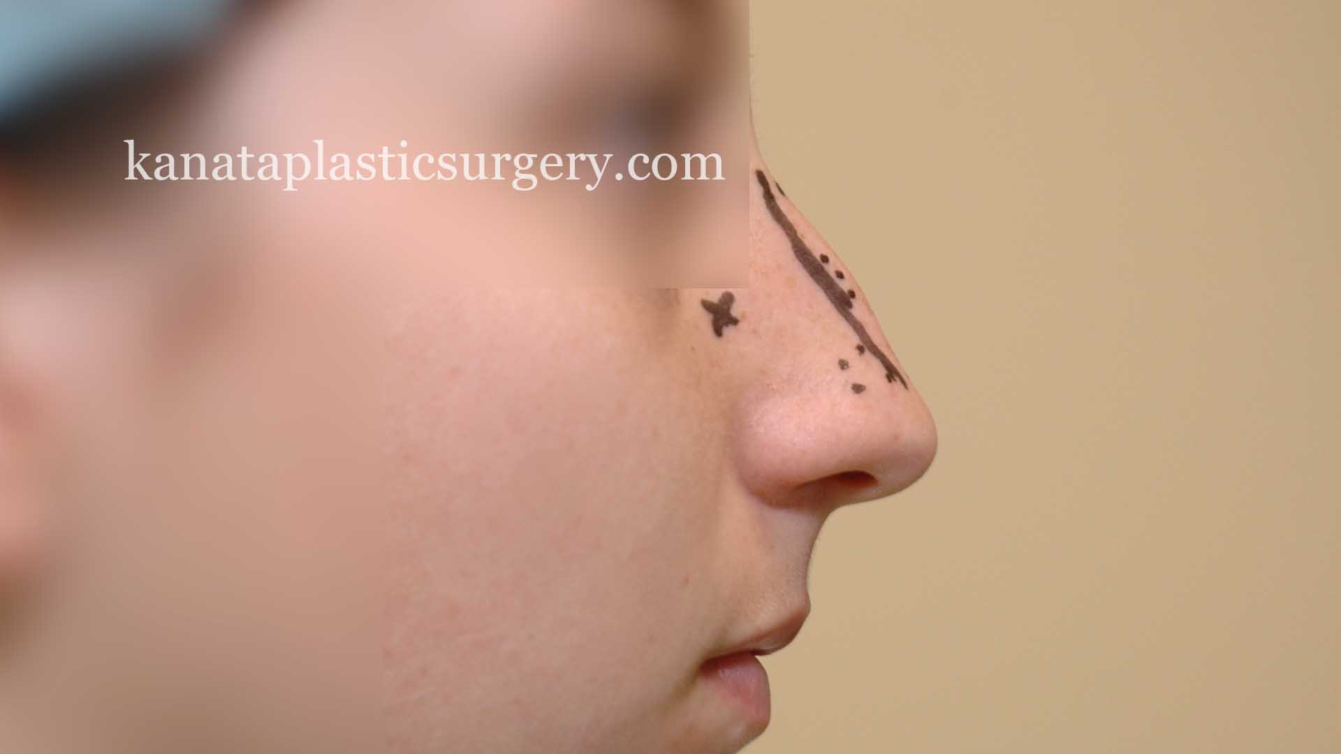 rhinoplasty nose job surgeon Ottawa 1