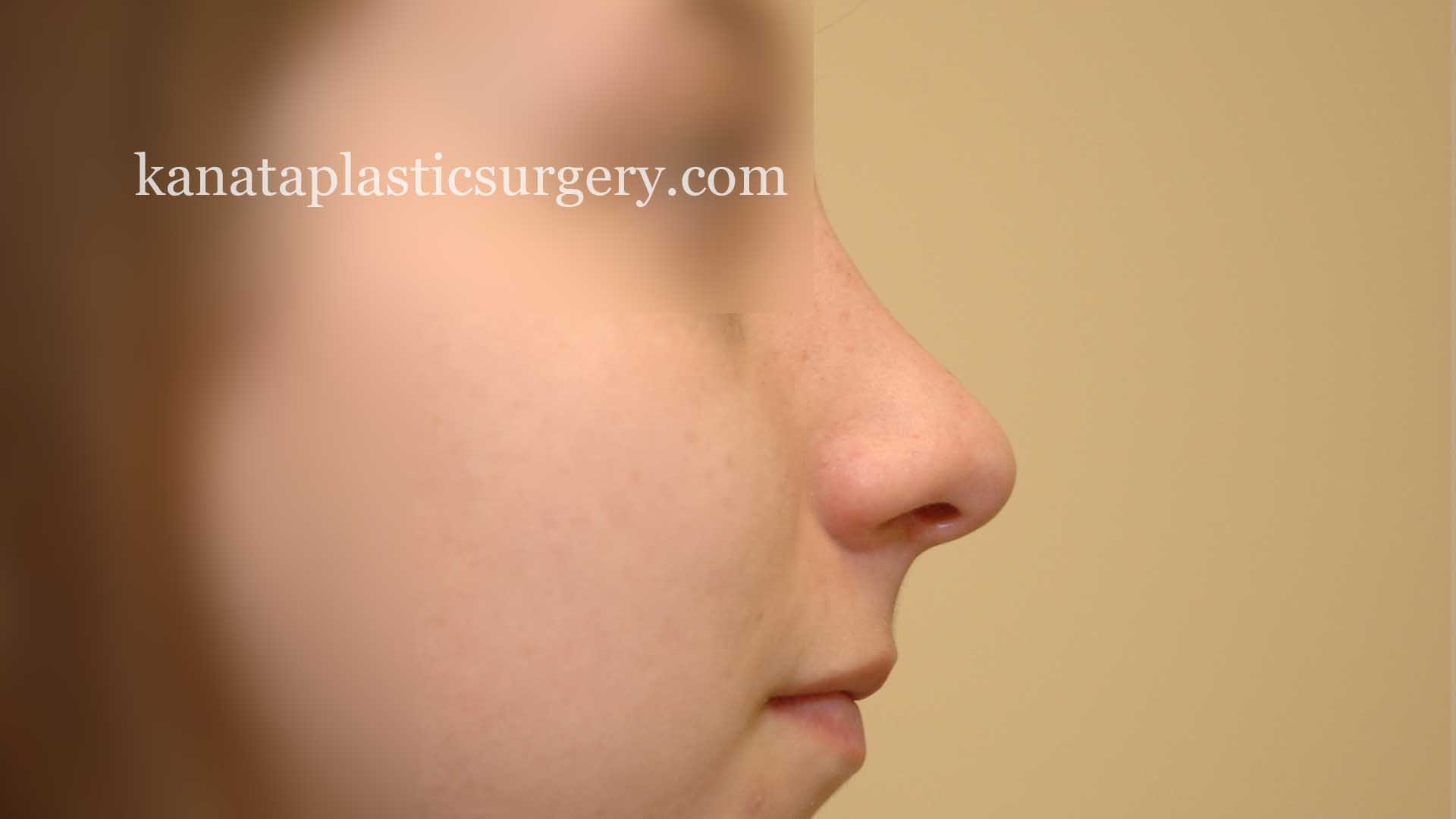 rhinoplasty nose job surgeon Ottawa 2