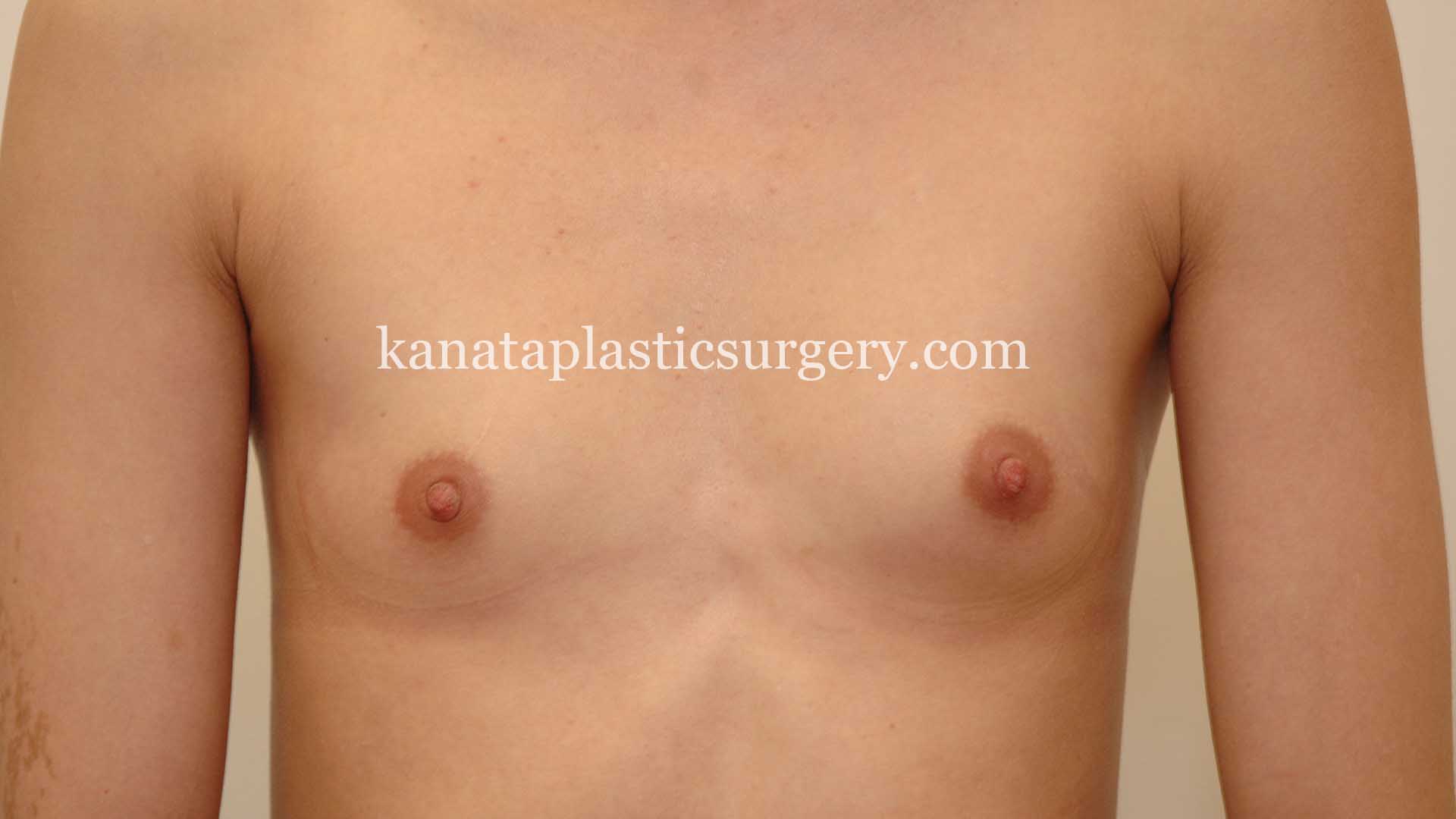 saline breast implants ottawa 1