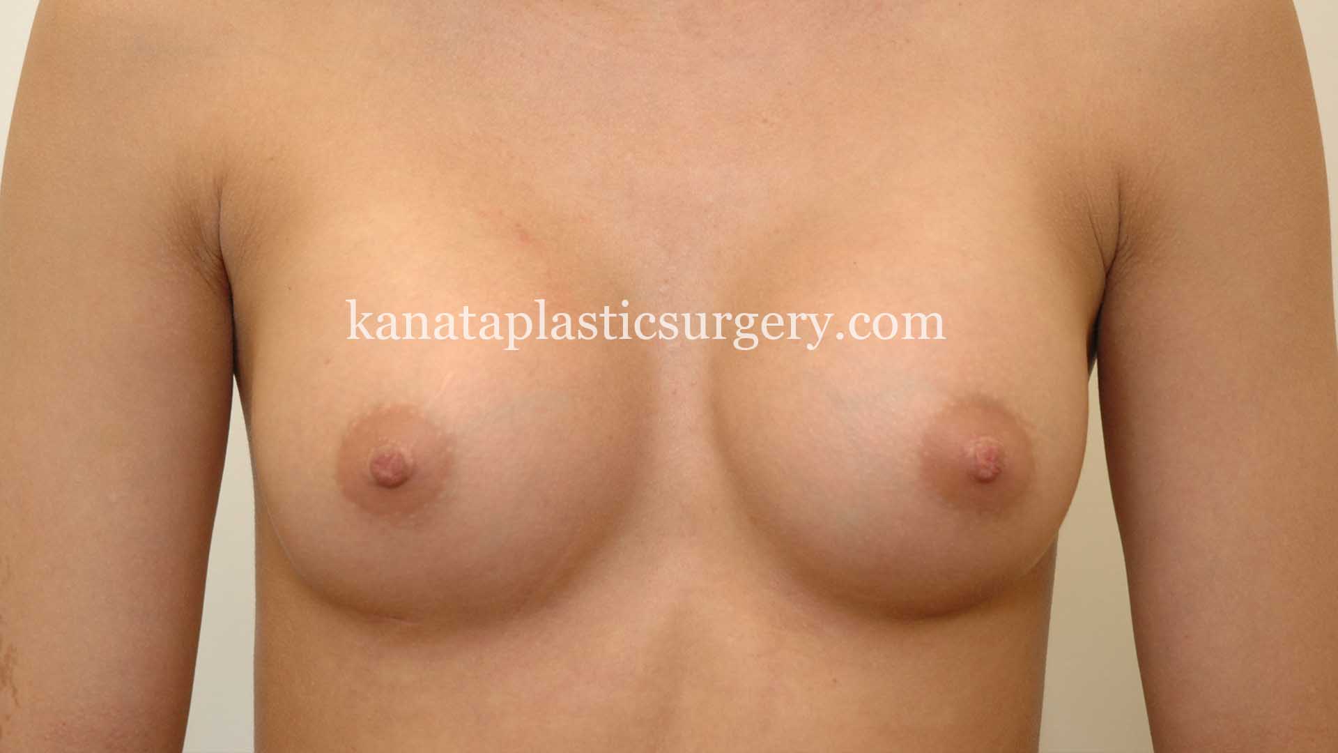 saline breast implants ottawa 2