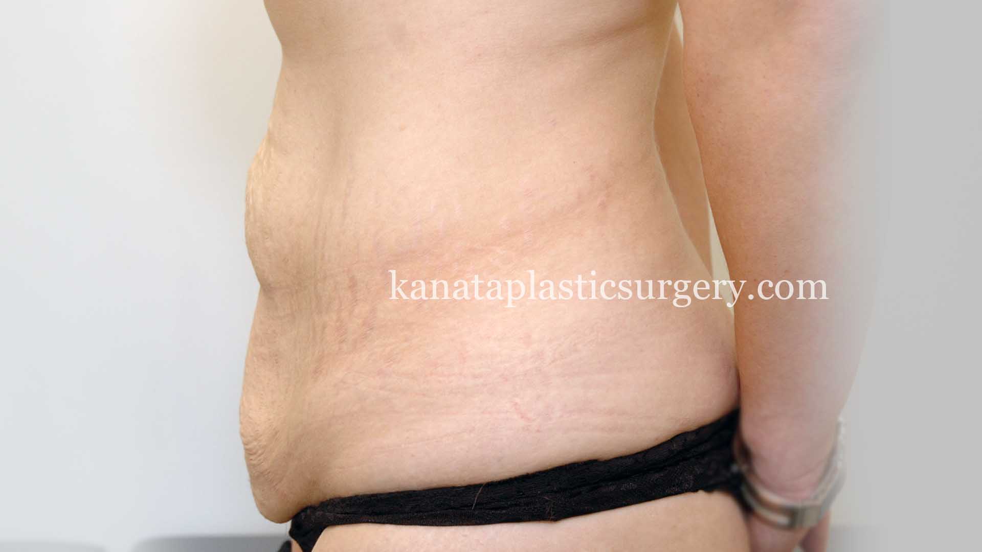 stomach fat liposuction 1