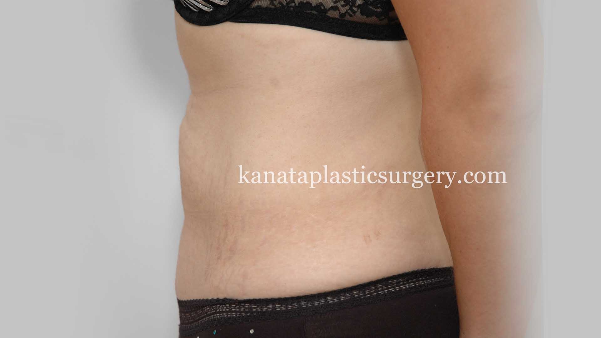 stomach fat liposuction 2