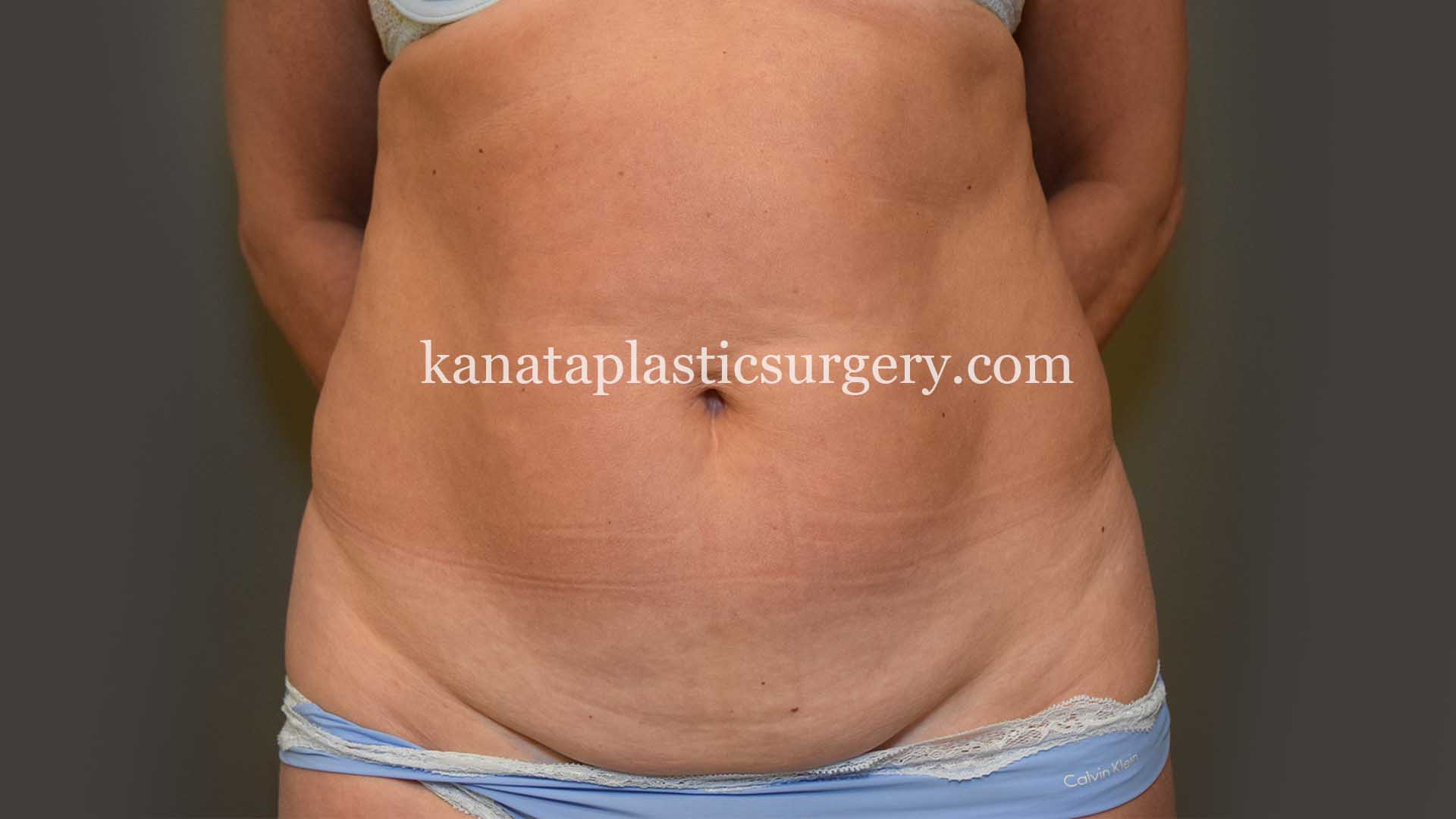 stomach liposuction fat 1