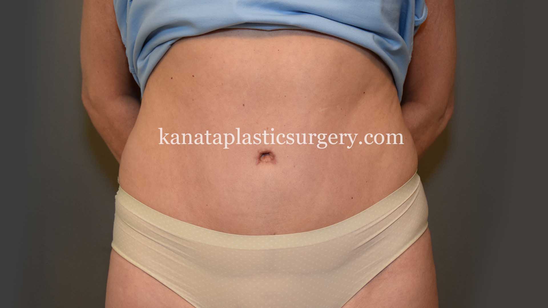 stomach liposuction fat 2